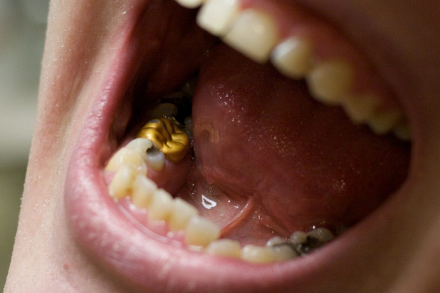 استخدامات الذهب الأسنان